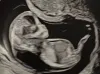 An ultrasound image of Jennifer Adkins’ 12-week-old fetus that was diagnosed with Turner syndrome and hydrops fetalis, two